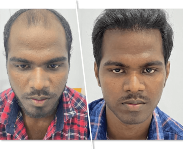 imgi_2_Hair-Transplantation_1
