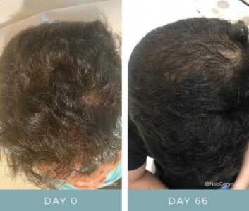 imgi_3_Hair-Loss-Aswain-BA-1024x870-1