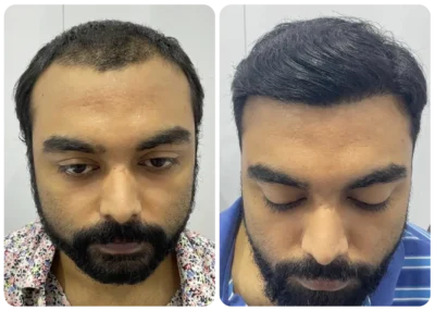imgi_7_prp-hair-treatment-before-after-3
